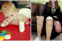 Những bệnh nhân cụt tứ chi vì viêm màng não mô cầu