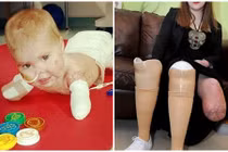 Những bệnh nhân cụt tứ chi vì viêm màng não mô cầu