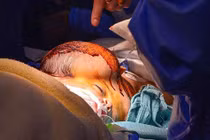 Tách thành công cặp song sinh dính liền đầu bẩm sinh