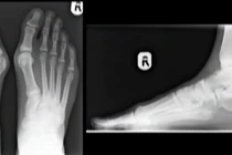 Hình ảnh 3D bàn chân chấn thương do đi giày cao gót