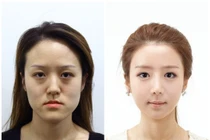 Cặp đôi song sinh thành mỹ nhân nhờ dao kéo