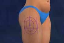 Zoom cận cảnh hút mỡ đùi bằng công nghệ Lazer