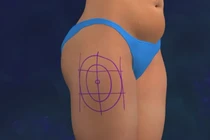 Zoom cận cảnh hút mỡ đùi bằng công nghệ Lazer