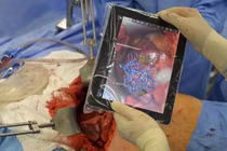 Cận cảnh một ca phẫu thuật gan bằng... máy tính bảng