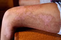 5 bé gái bị bỏng khủng khiếp do... nước chanh