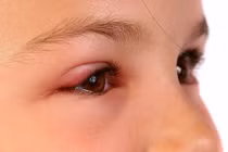 Hình ảnh đau mắt đỏ ở trẻ em: ủ đến phát bệnh