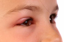 Hình ảnh đau mắt đỏ ở trẻ em: ủ đến phát bệnh