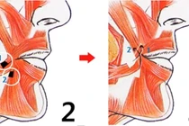 Tận mục quy trình cắt miệng xinh như "hot girl" Hàn