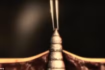 Rùng mình dòi ăn thịt làm tổ dưới da