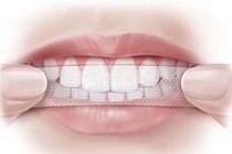 Hậu họa khôn lường từ miếng dán trắng tẩy răng