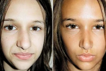 Cơn sốt phẫu thuật thẩm mỹ của “teen”