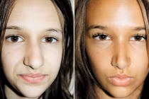 Cơn sốt phẫu thuật thẩm mỹ của “teen”