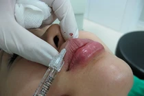 Hành trình 30 lần “dao kéo” của nữ MC Trung Quốc