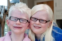 Nghị lực phi thường của hai chị em bị bạch tạng