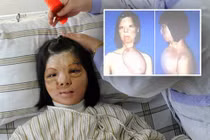 Tái tạo mặt bằng cách nuôi da trên ngực