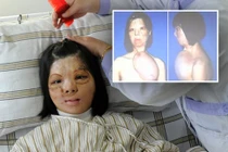 Tái tạo mặt bằng cách nuôi da trên ngực