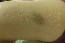 Tắm trắng, gái trẻ bị “lột da” loang lổ toàn thân