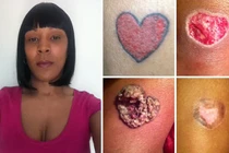 Rùng mình chân phồng rộp kinh hoàng do xăm hình