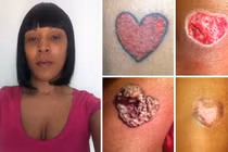 Rùng mình chân phồng rộp kinh hoàng do xăm hình