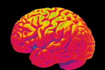 Đau nửa đầu có thể gây tổn thương não vĩnh viễn