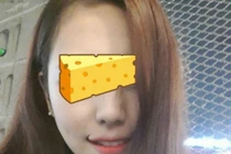 Phát cuồng kiểu phẫu thuật miệng hình cánh cung