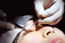 Zoom cận cảnh phẫu thuật cắt mí mắt