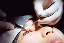 Zoom cận cảnh phẫu thuật cắt mí mắt