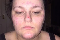 Kinh hoàng căn bệnh lạ khiến gái trẻ phải hoãn cưới khẩn cấp