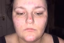 Kinh hoàng căn bệnh lạ khiến gái trẻ phải hoãn cưới khẩn cấp