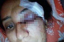 Đánh vợ đến sảy thai, mù mắt vì không được mua ô tô