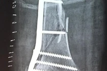 Cứu sống bệnh nhân gãy xương - tổn thương phức tạp động mạch đùi