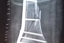 Cứu sống bệnh nhân gãy xương - tổn thương phức tạp động mạch đùi