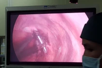 Phẫu thuật rút đinh dài 12cm xuyên qua đỉnh phổi