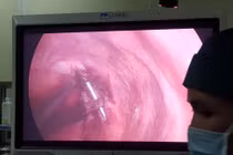 Phẫu thuật rút đinh dài 12cm xuyên qua đỉnh phổi