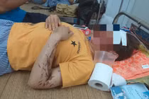 Vụ tạt axít vào phụ bếp ở Hòa Bình: Nạn nhân từng bị đe dọa giết 