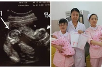 Sản phụ sinh 2 con cùng lúc nhưng bác sĩ lại nói “không phải là cặp song sinh”