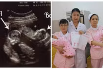 Sản phụ sinh 2 con cùng lúc nhưng bác sĩ lại nói “không phải là cặp song sinh”