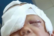 Thái Nguyên: Bé 20 tháng tuổi bị chó nhà cắn rách mặt 