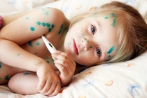 3 bệnh dễ truyền nhiễm trong mùa nồm ẩm