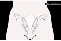 Ca cấy ghép tử cung đầu tiên tại Mỹ thất bại