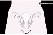 Ca cấy ghép tử cung đầu tiên tại Mỹ thất bại