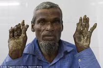 Kỳ lạ cả gia đình 3 người mắc hội chứng người cây 