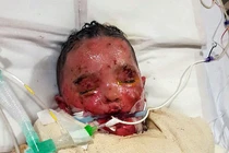 Cậu bé suýt chết oan vì bị chẩn đoán nhầm thủy đậu