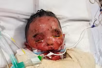 Cậu bé suýt chết oan vì bị chẩn đoán nhầm thủy đậu