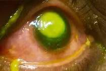 Đeo kính áp tròng ngủ qua đêm bị vi khuẩn ăn mòn giác mạc