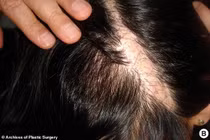 Bỏng sâu da đầu vì nhuộm tóc, cô gái 21 tuổi mang vết sẹo ám ảnh suốt đời