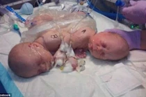 Thương tâm những bé sinh đôi có 2 đầu
