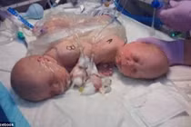 Thương tâm những bé sinh đôi có 2 đầu