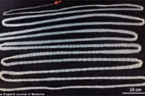 Kinh hãi sán dài hơn 6m làm tổ trong ruột