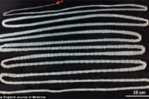 Kinh hãi sán dài hơn 6m làm tổ trong ruột